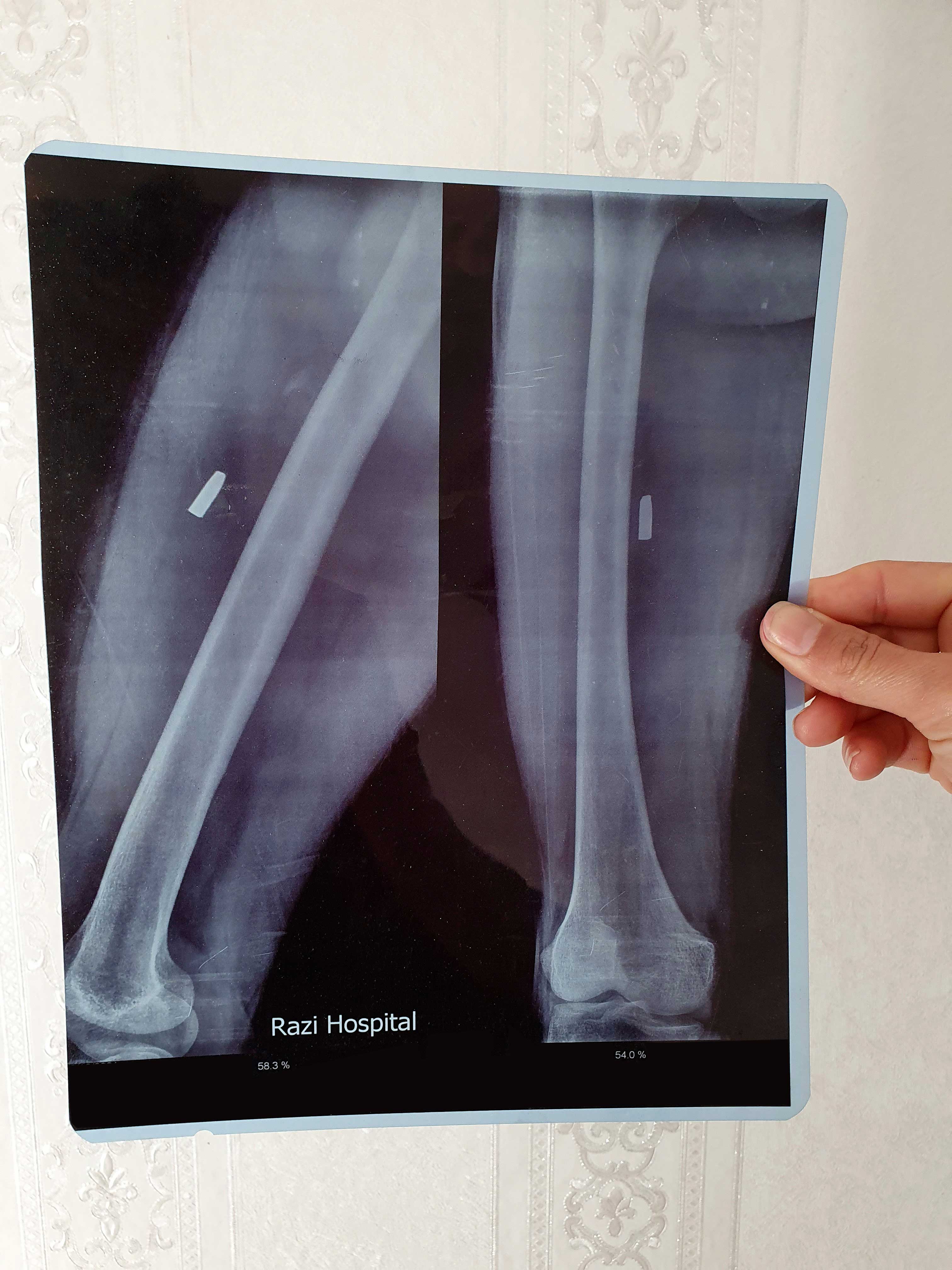 Afghanistan Illegale Pushbacks Und Gewalt Iran Grenze Bullet Wounds X Ray[1]